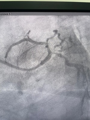 Pre angioplasty