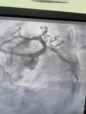 Post angioplasty