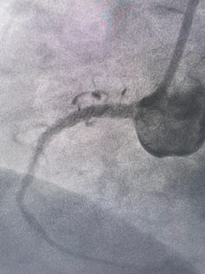 Post angioplasty