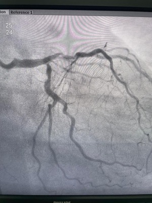 Pre angioplasty