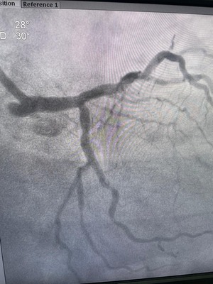 Post angioplasty