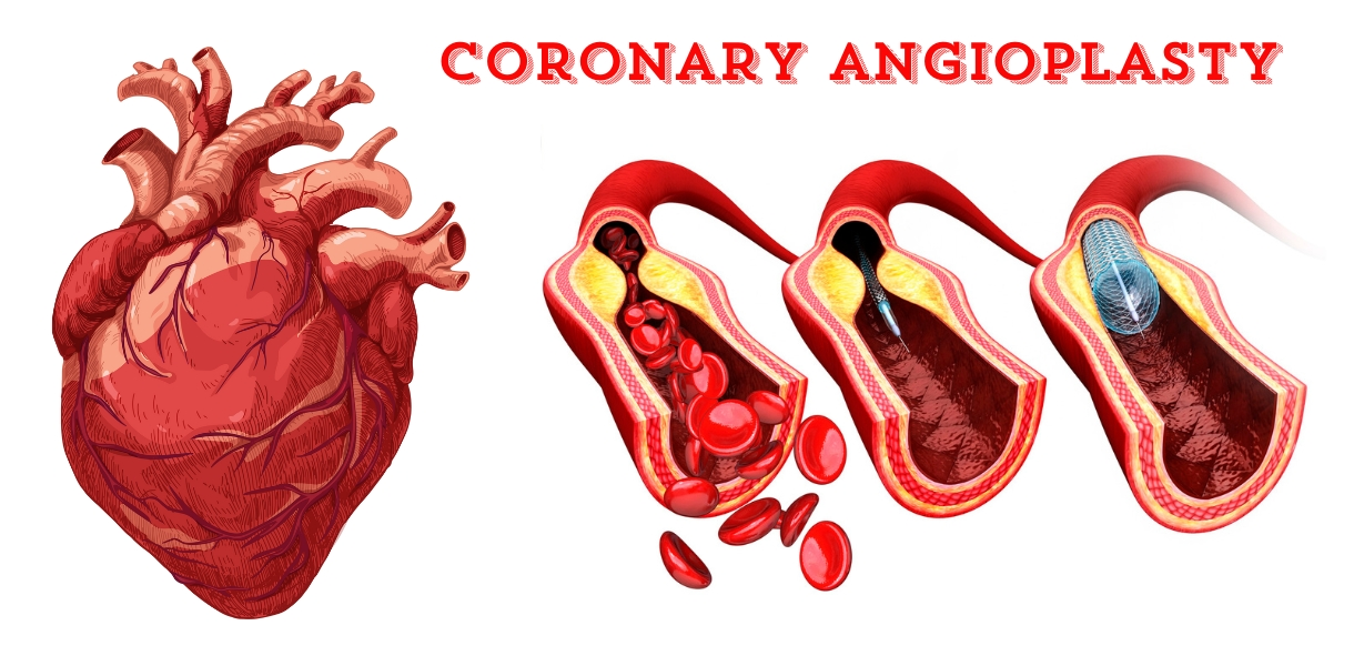 Coronary Angioplasty in pune