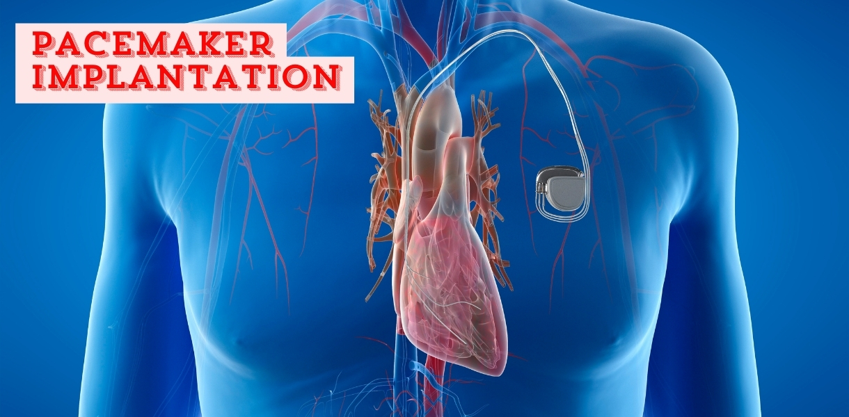 Pacemaker Implantation