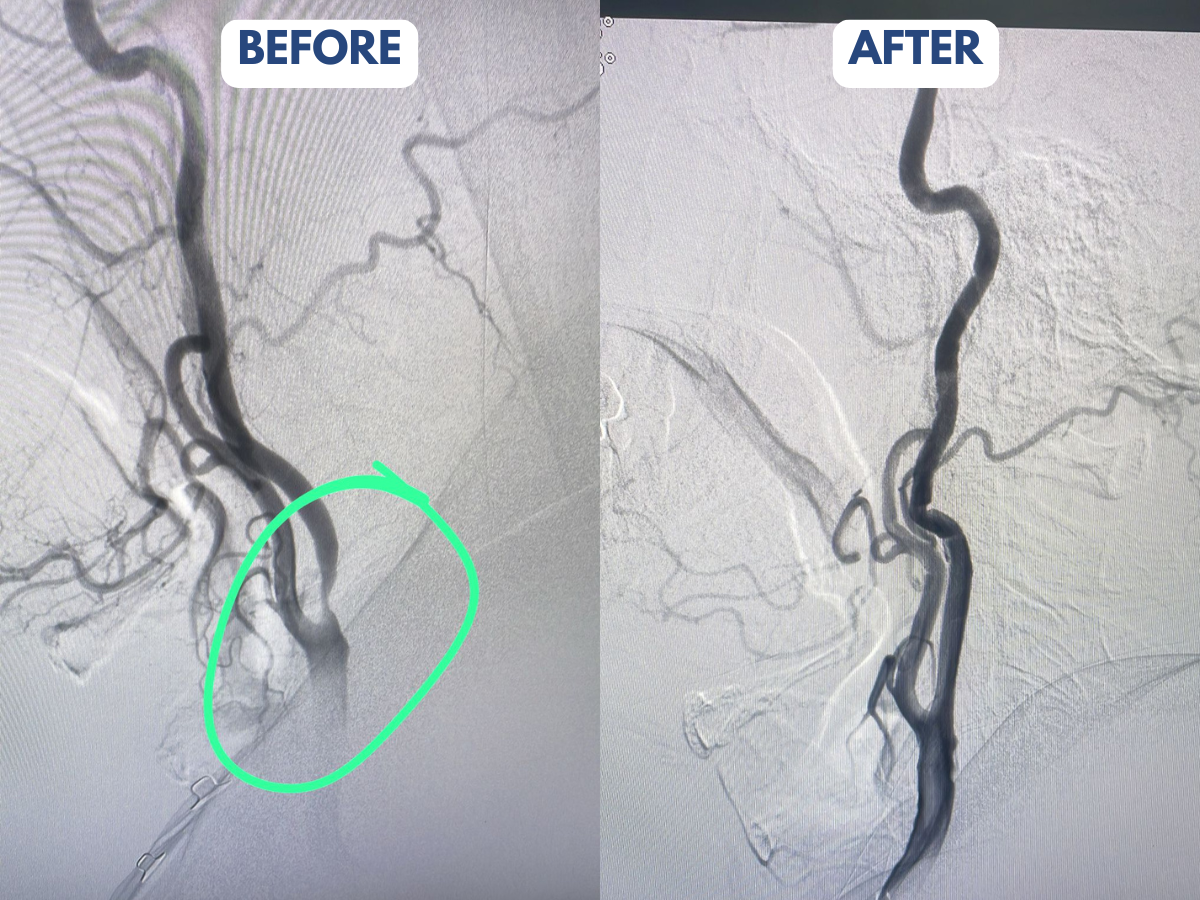 Carotid Intervention Dr. Anesh Jain