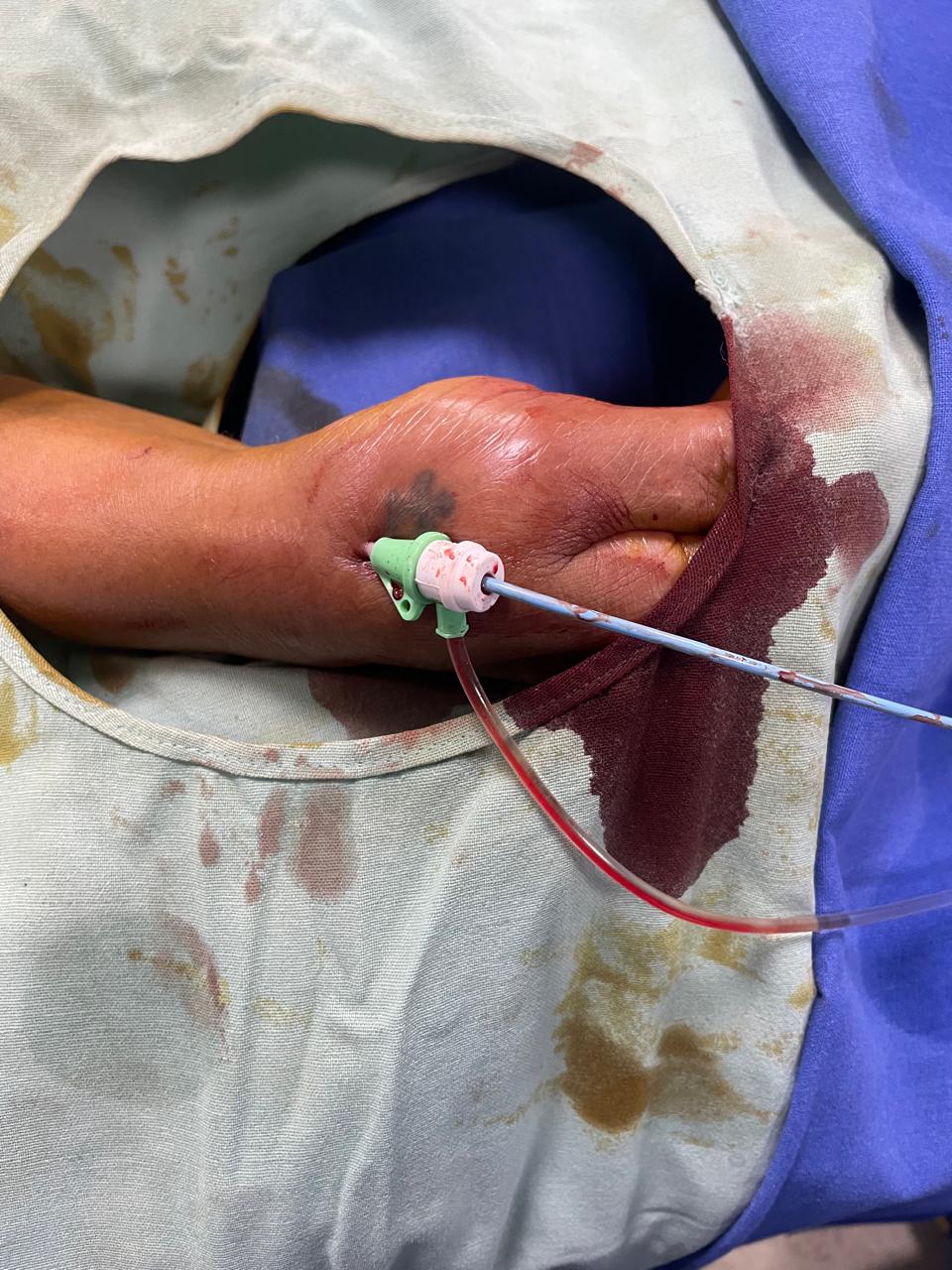 Angioplasty Through Thumb