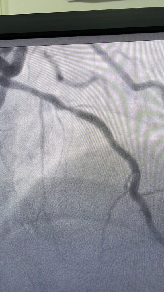 Pre- Angioplasty