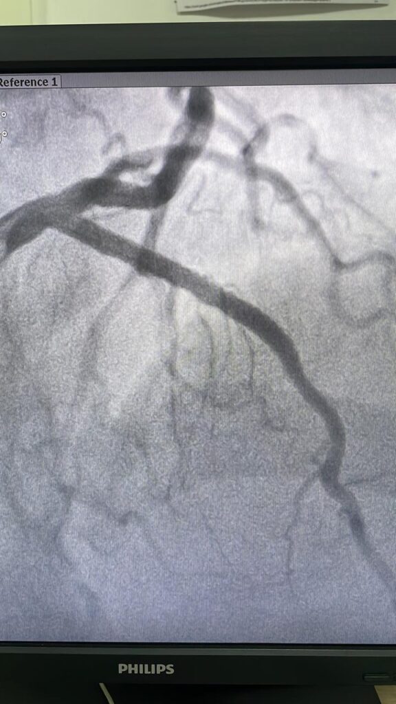 Post- Angioplasty